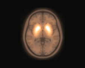 brain imaging in Parkinson's disease