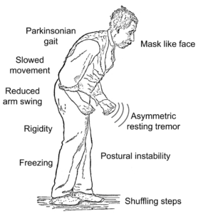 symptoms of Parkinson's disease