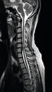 Herniated disc MRI image