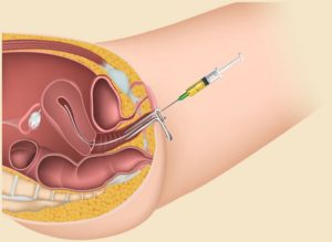 introducing ayurvedic medicines into uterus to treat infertility